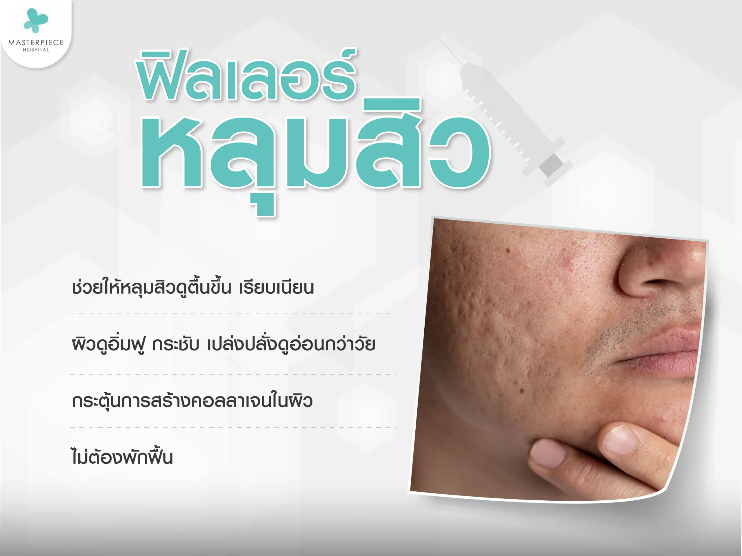 ฟิลเลอร์หลุมสิว