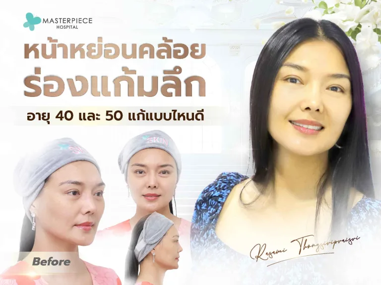 หน้าหย่อนคล้อย ร่องแก้มลึก อายุ 40 และ 50 แก้แบบไหนดี