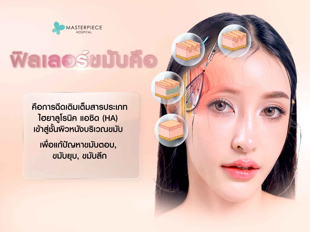 ฟิลเลอร์ขมับคือ