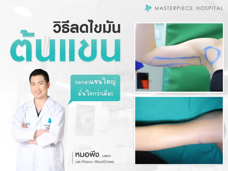 วิธีลดไขมันต้นแขน บอกลาแขนใหญ่ มั่นใจกว่าเดิม
