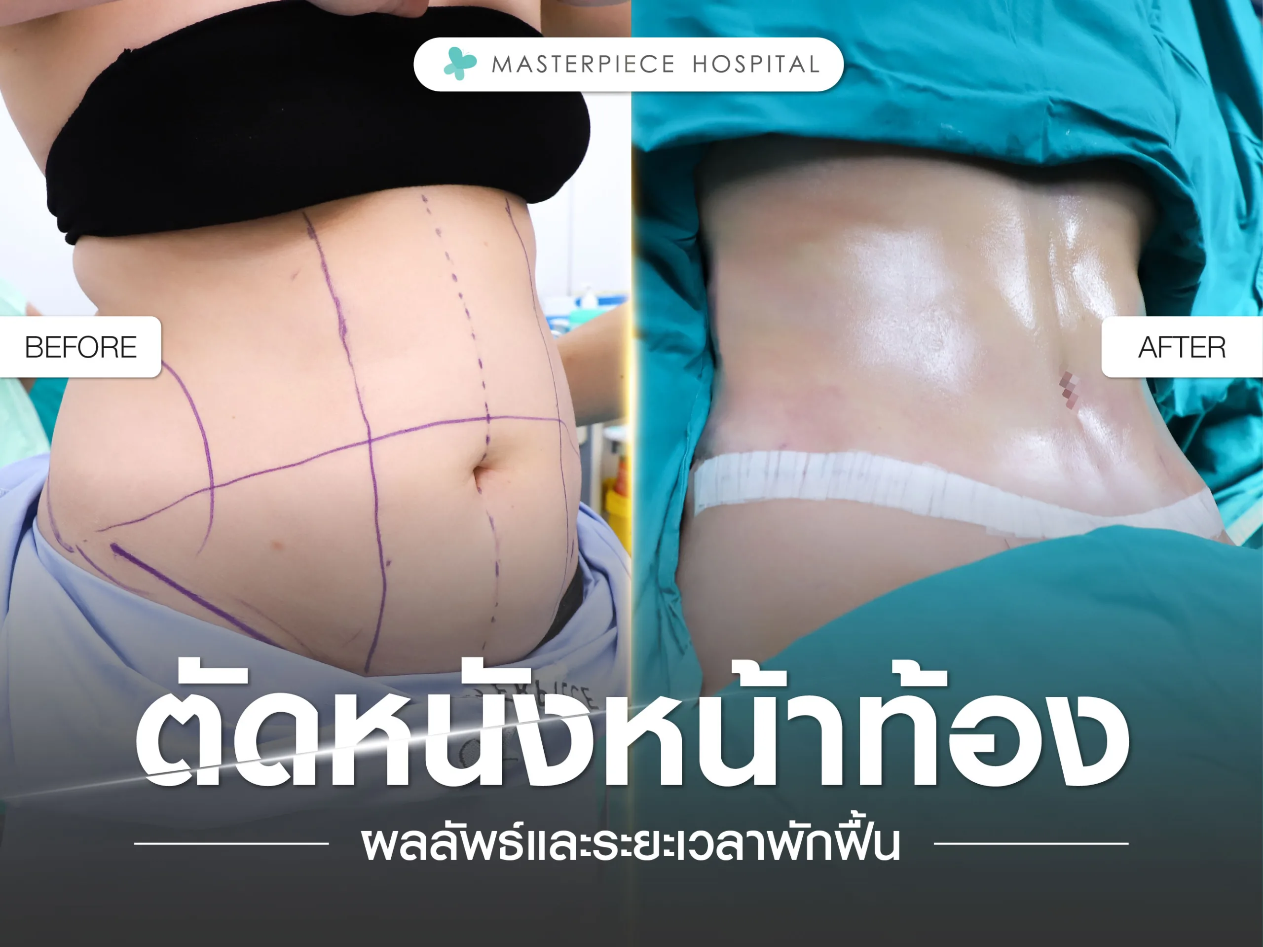 ผลลัพธ์หลังตัดหนังหน้าท้อง และระยะเวลาพักฟื้น