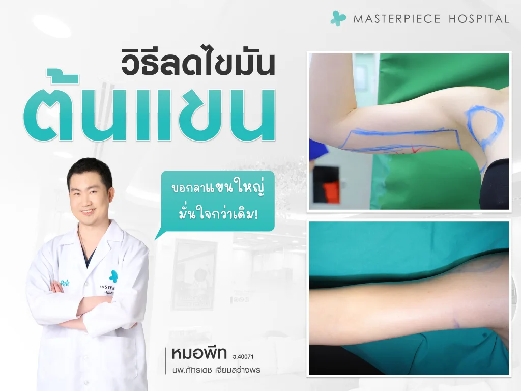 วิธีลดไขมันต้นแขน
