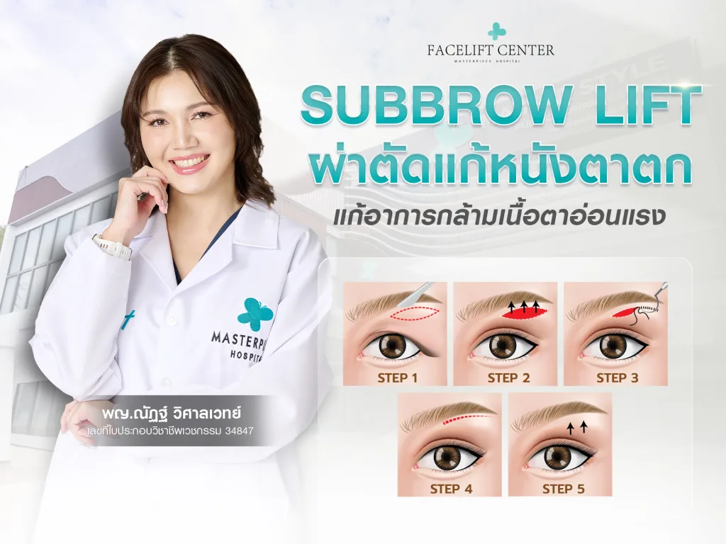 Subbrow lift ผ่าตัดแก้หนังตาตก แก้อาการกล้ามเนื้อหนังตาอ่อนแรง