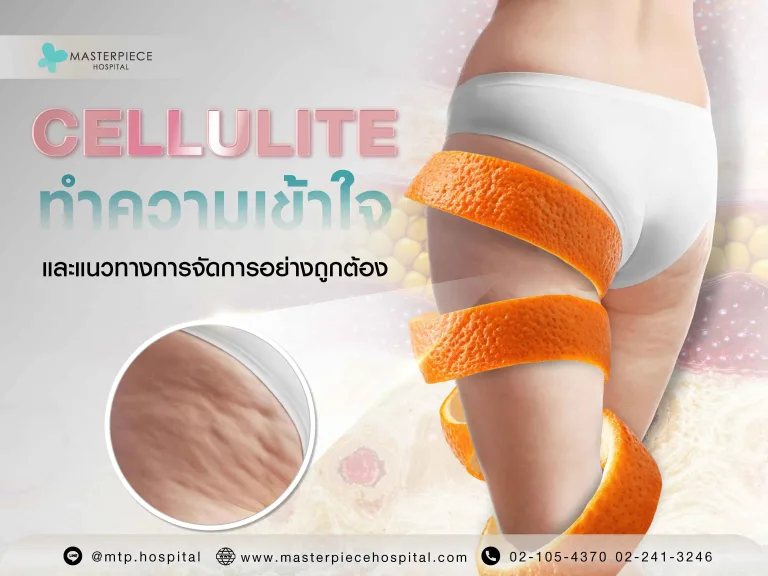 เซลลูไลท์ ทำความเข้าใจสาเหตุและแนวทางการจัดการอย่างถูกต้อง