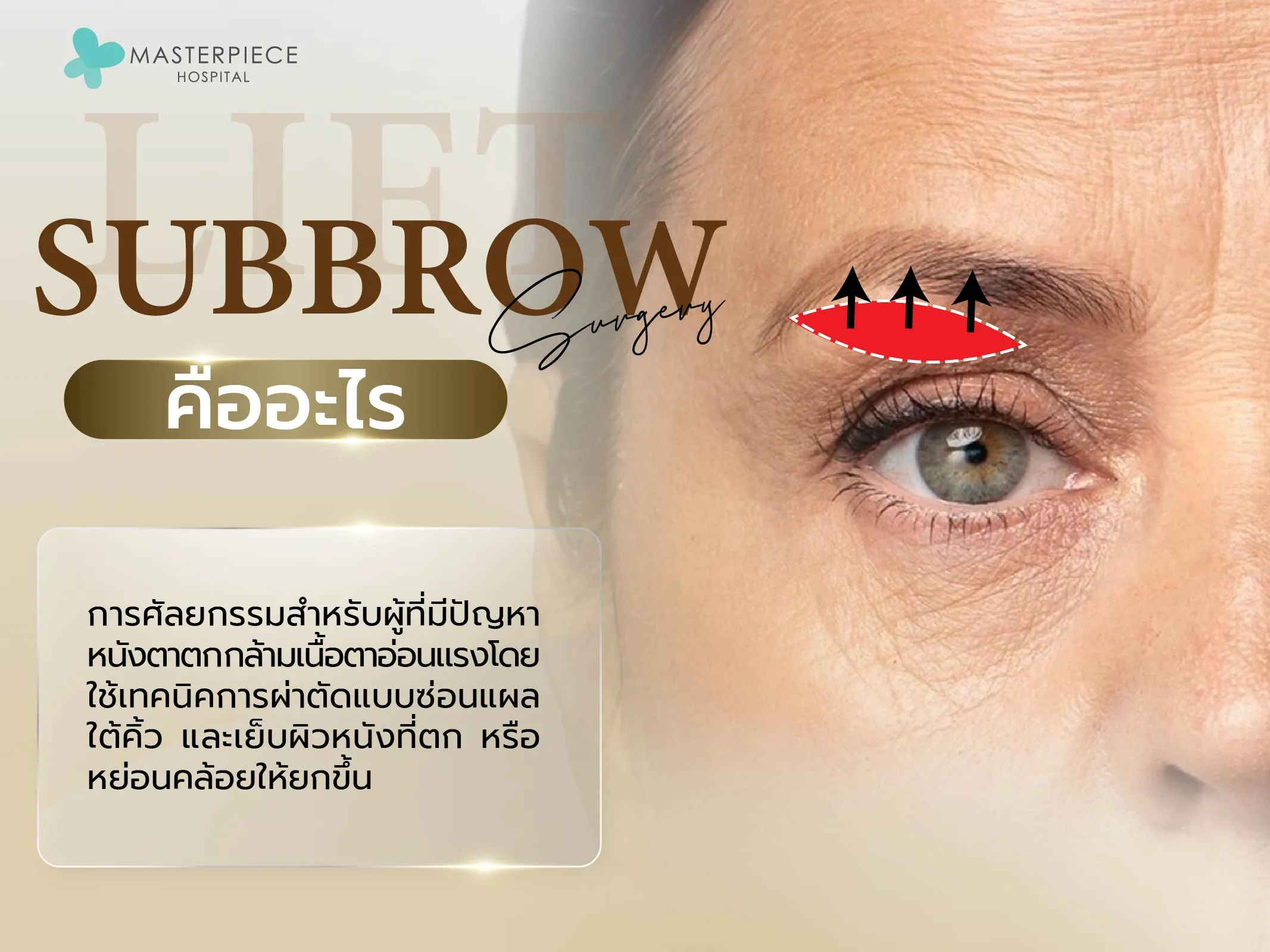Subbrow lift คืออะไร