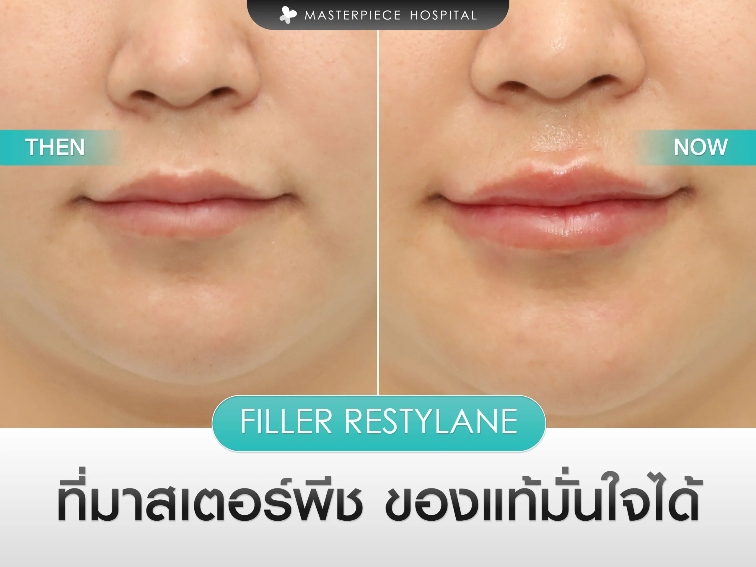 ฟิลเลอร์ restylane ที่มาสเตอร์พีช ของแท้มั่นใจได้