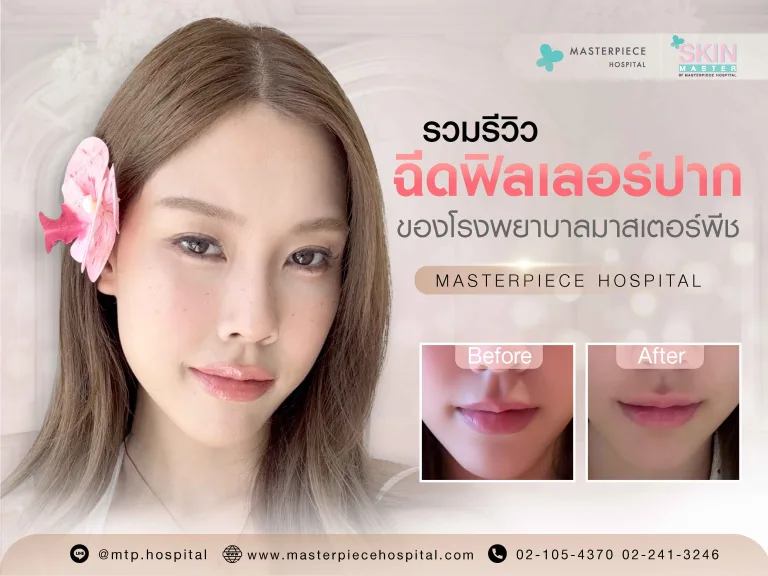 รวมรีวิวฉีดฟิลเลอร์ปากของโรงพยาบาลมาสเตอร์พีชก่อนและหลังทำ