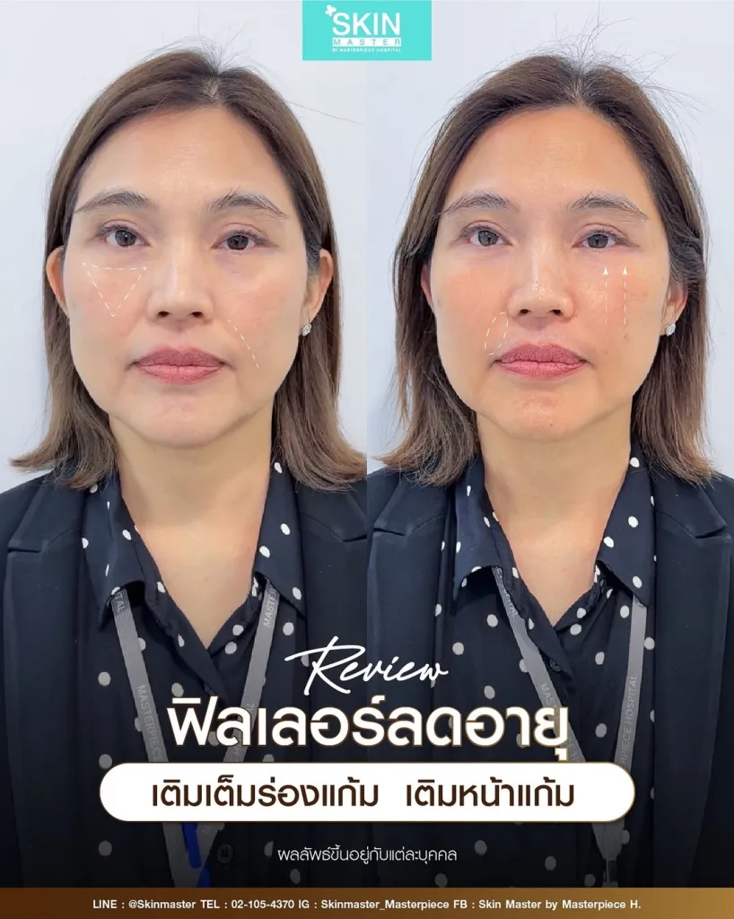 รีวิวฉีดฟิลเลอร์ร่องแก้ม