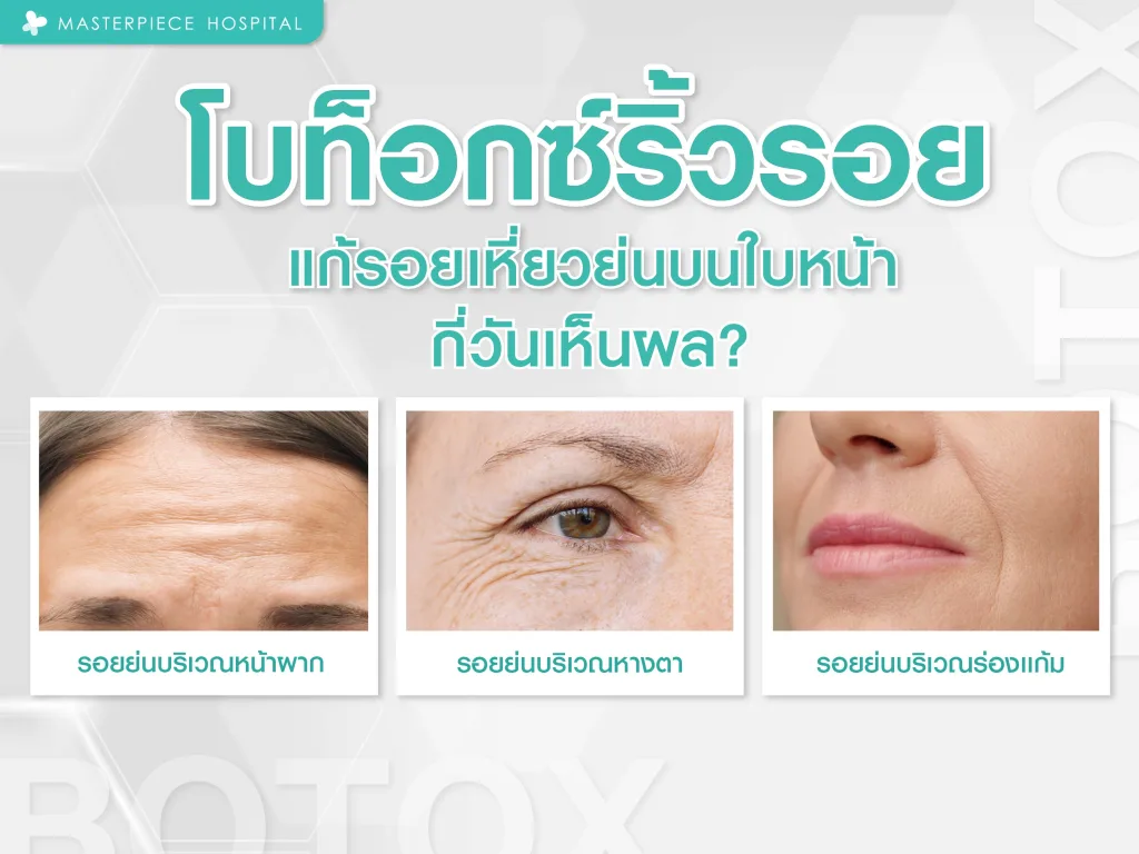 โบท็อกซ์ริ้วรอย แก้รอยเหี่ยวย่นบนใบหน้า กี่วันเห็นผล ?