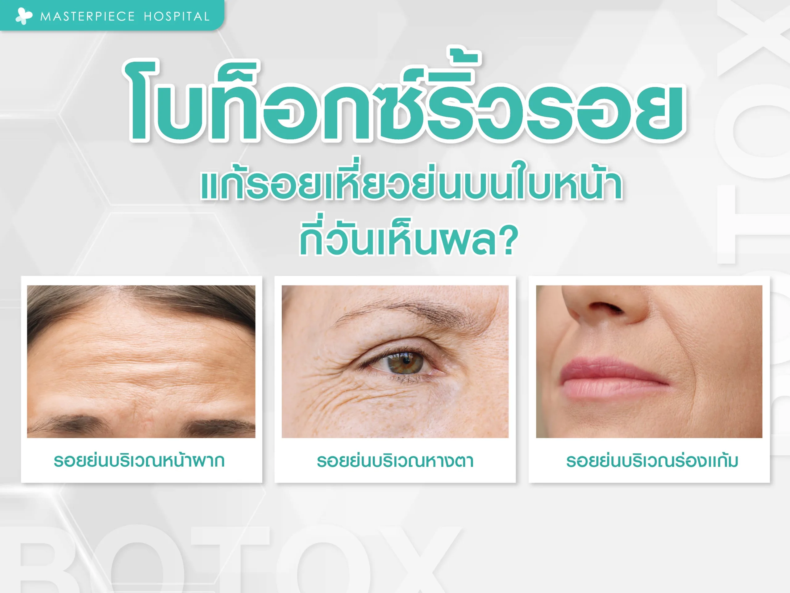 โบท็อกซ์ริ้วรอย แก้รอยเหี่ยวย่นบนใบหน้า กี่วันเห็นผล ?