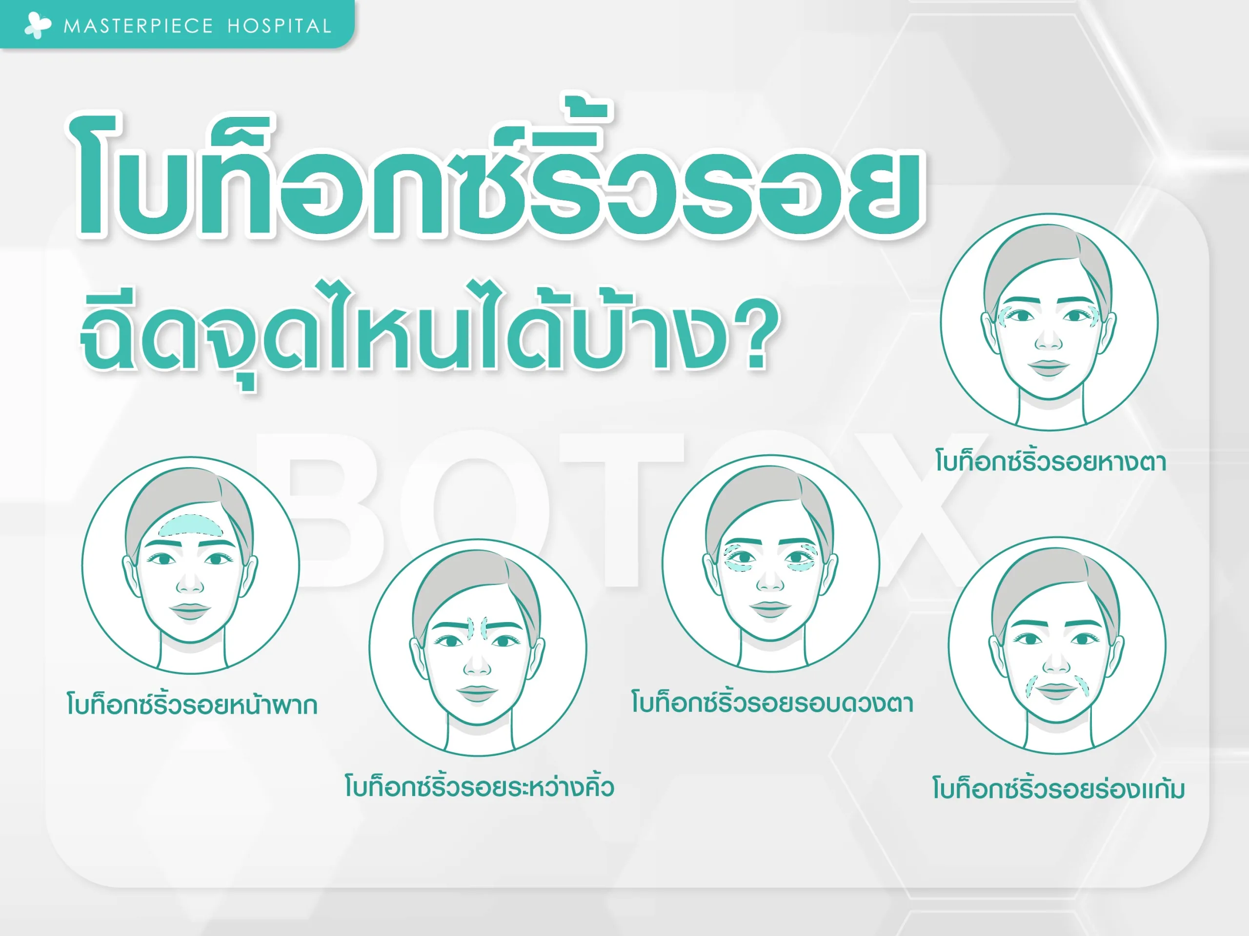 โบท็อกซ์ริ้วรอย ฉีดจุดไหนบ้าง