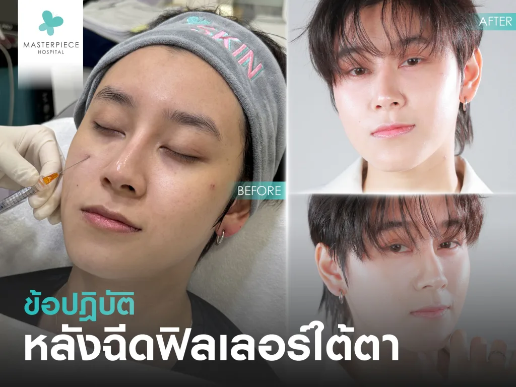 ข้อปฏิบัติหลังฉีด filler ใต้ตา