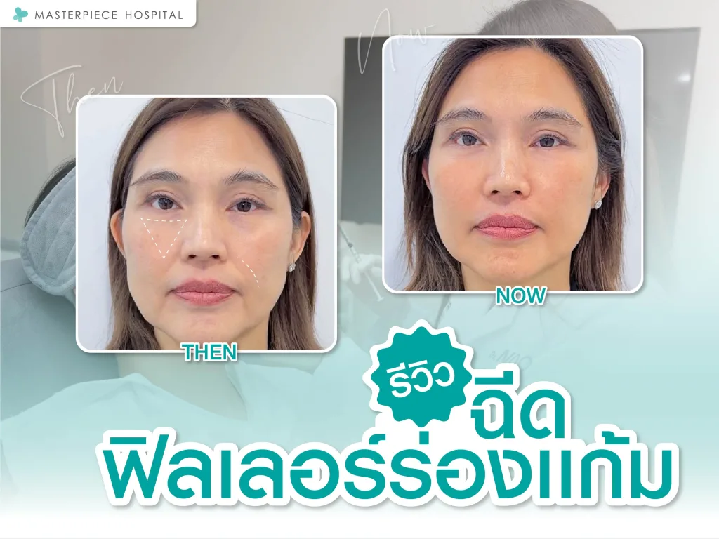 รีวิวฉีดฟิลเลอร์ร่องแก้ม