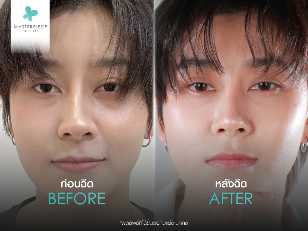 ฉีดฟิลเลอร์ใต้ตา