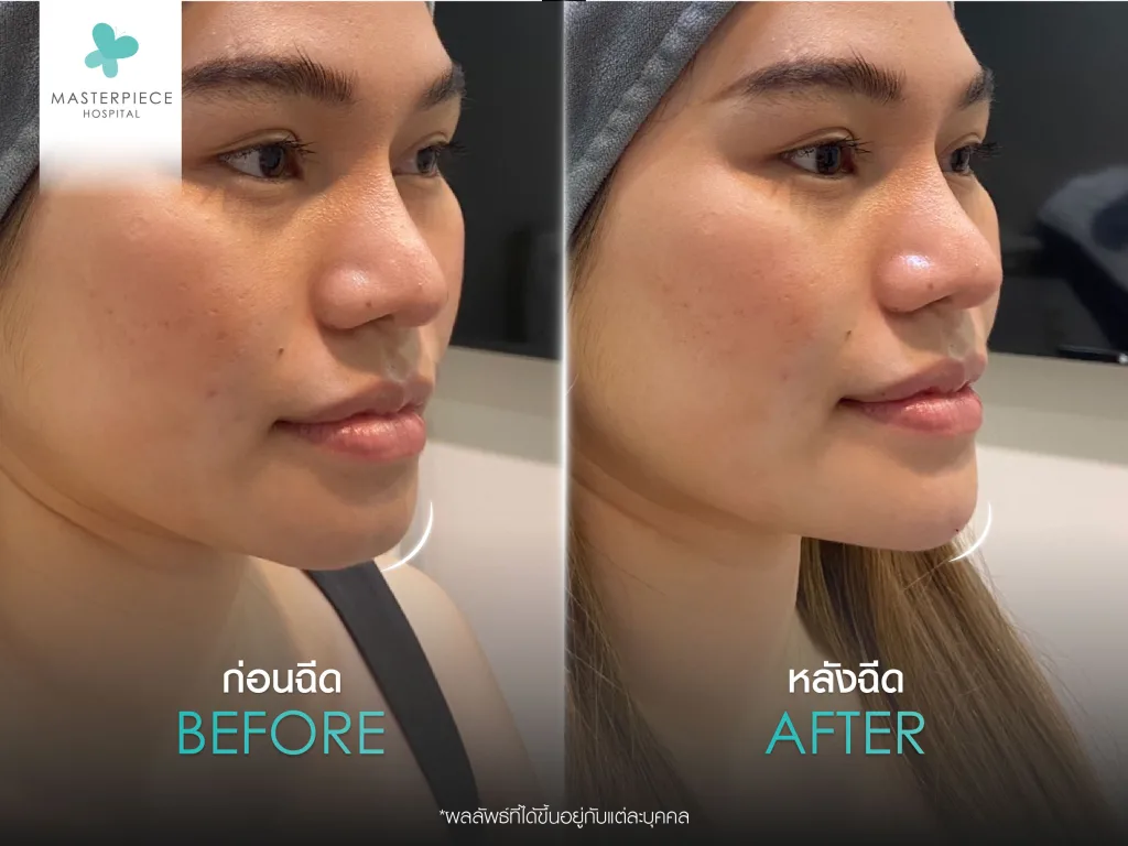 Befor & After ฉีดฟิลเลอร์คาง