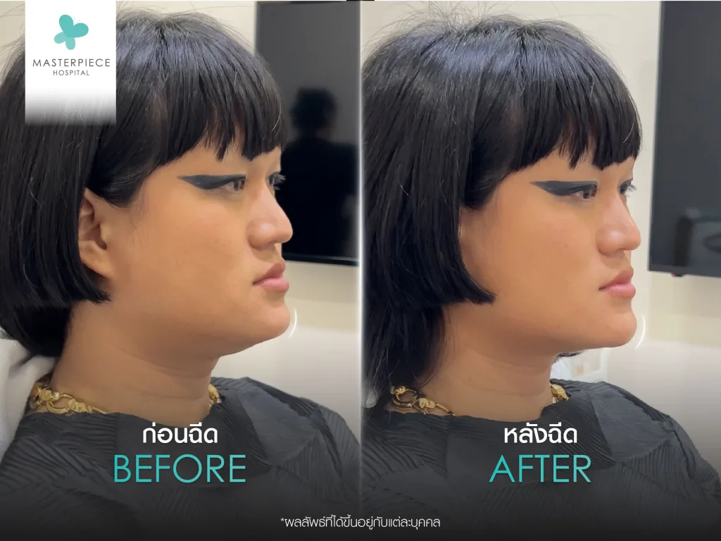 Befor & After ฉีดฟิลเลอร์คาง