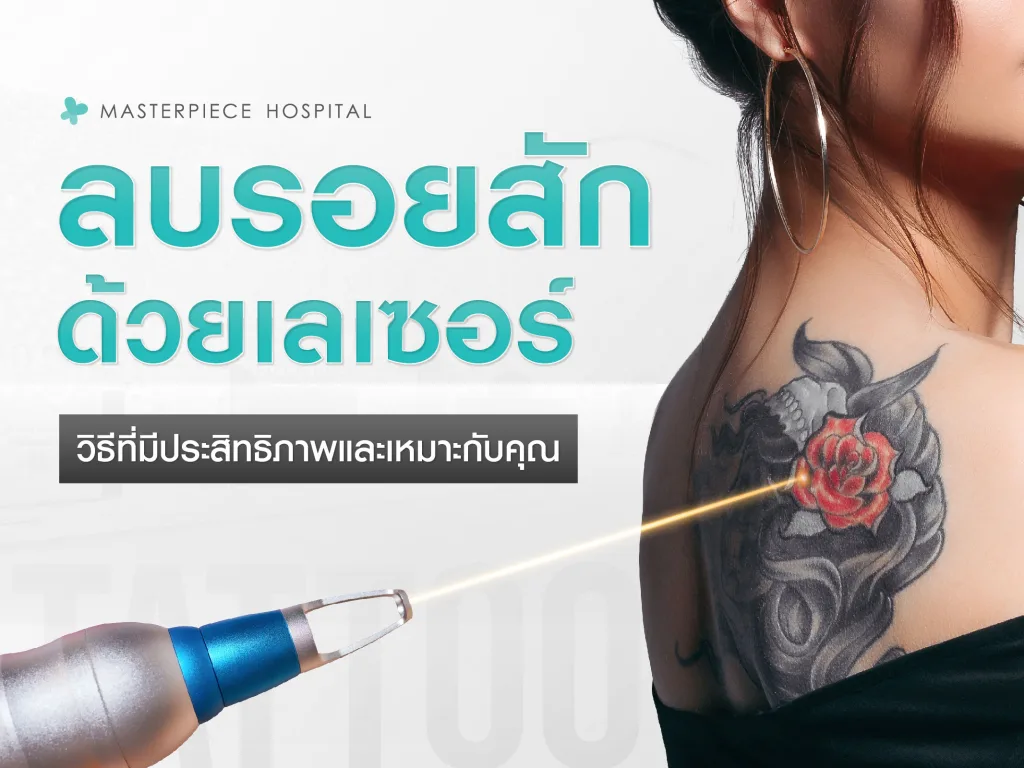 ลบรอยสักด้วยเลเซอร์: วิธีที่มีประสิทธิภาพและเหมาะกับคุณในปี 2025