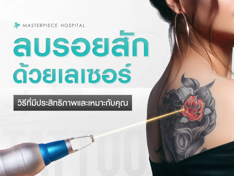 ลบรอยสักด้วยเลเซอร์: วิธีที่มีประสิทธิภาพและเหมาะกับคุณในปี 2025