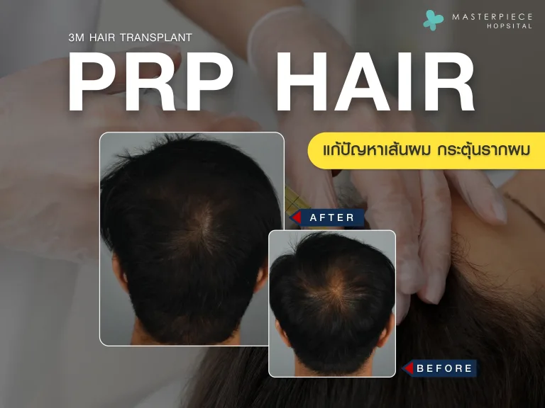 PRP ผม ( Prp hair treatment ) แก้ปัญหาเส้นผม กระตุ้นรากผม
