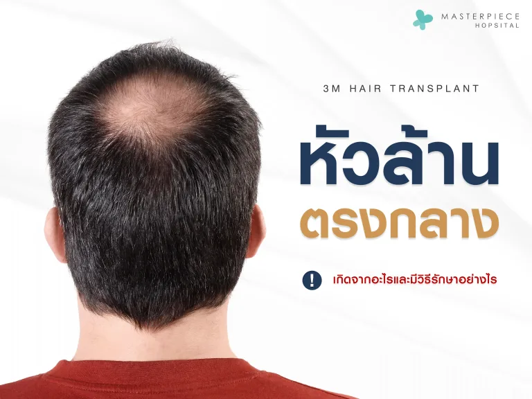 หัวล้านตรงกลาง หัวไข่ดาว เกิดจาก มีวิธีรักษาอย่างไร