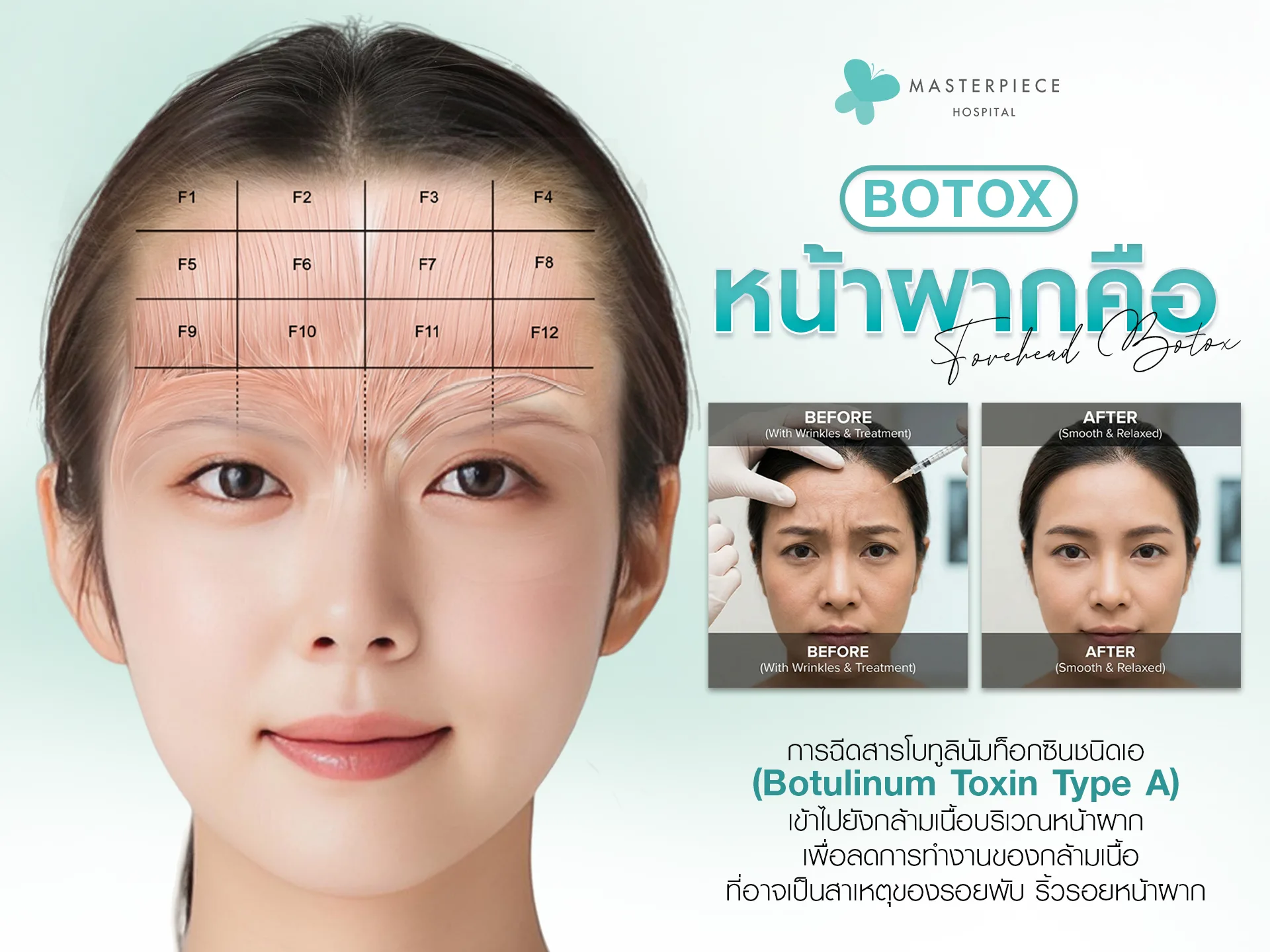 โบท็อกซ์หน้าผากคือ