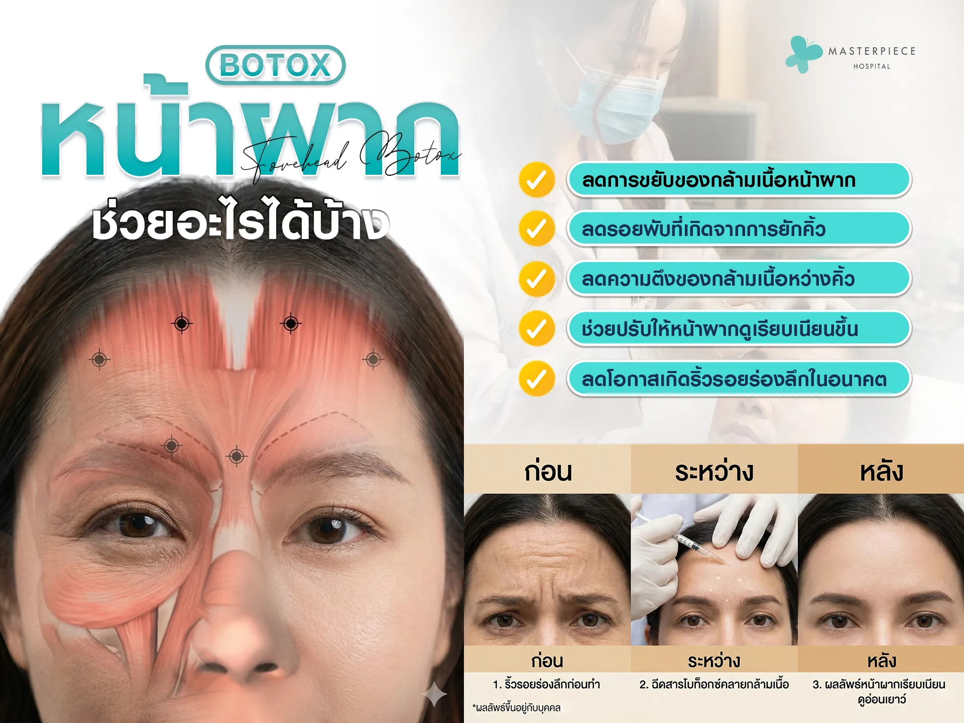 โบท็อกซ์หน้าผาก