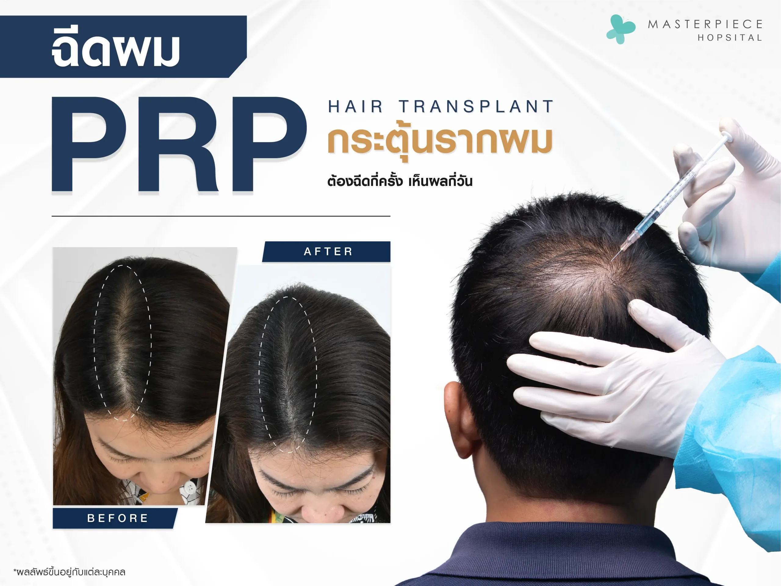ฉีด prp ผม