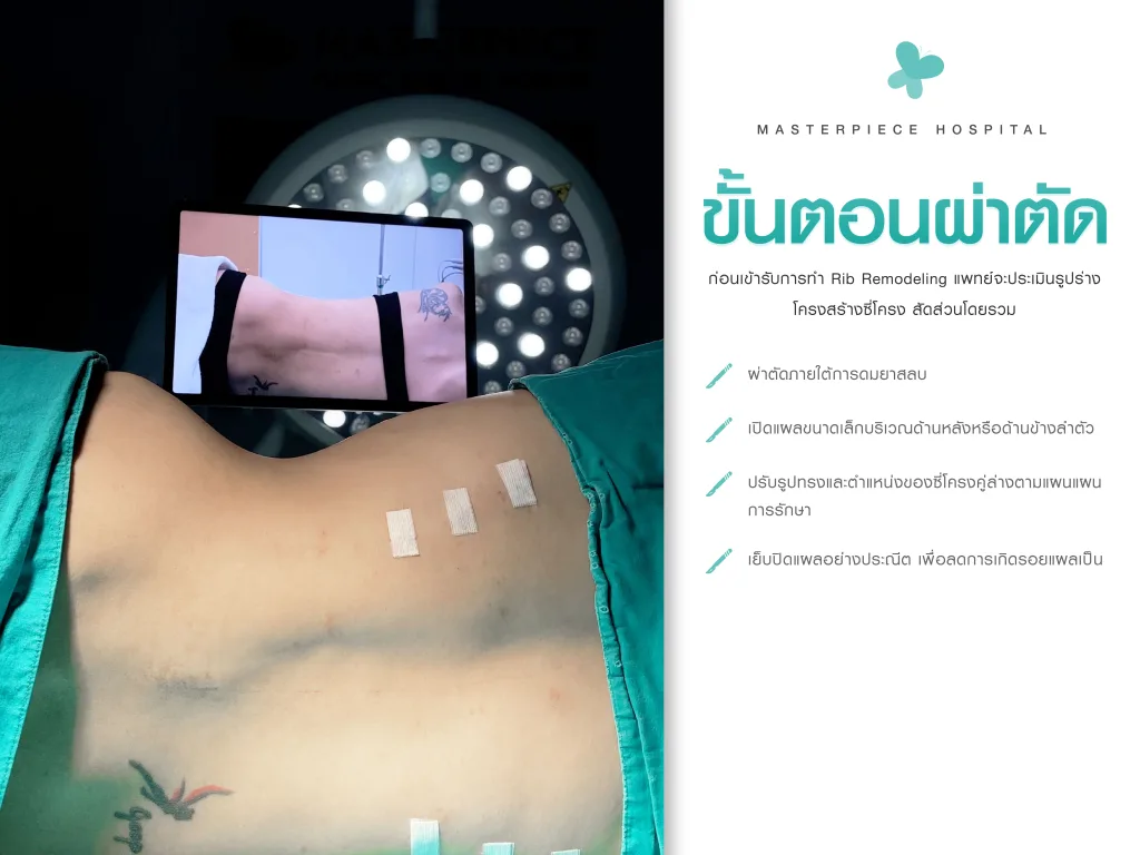ขั้นตอนการผ่าตัด Rib modeling