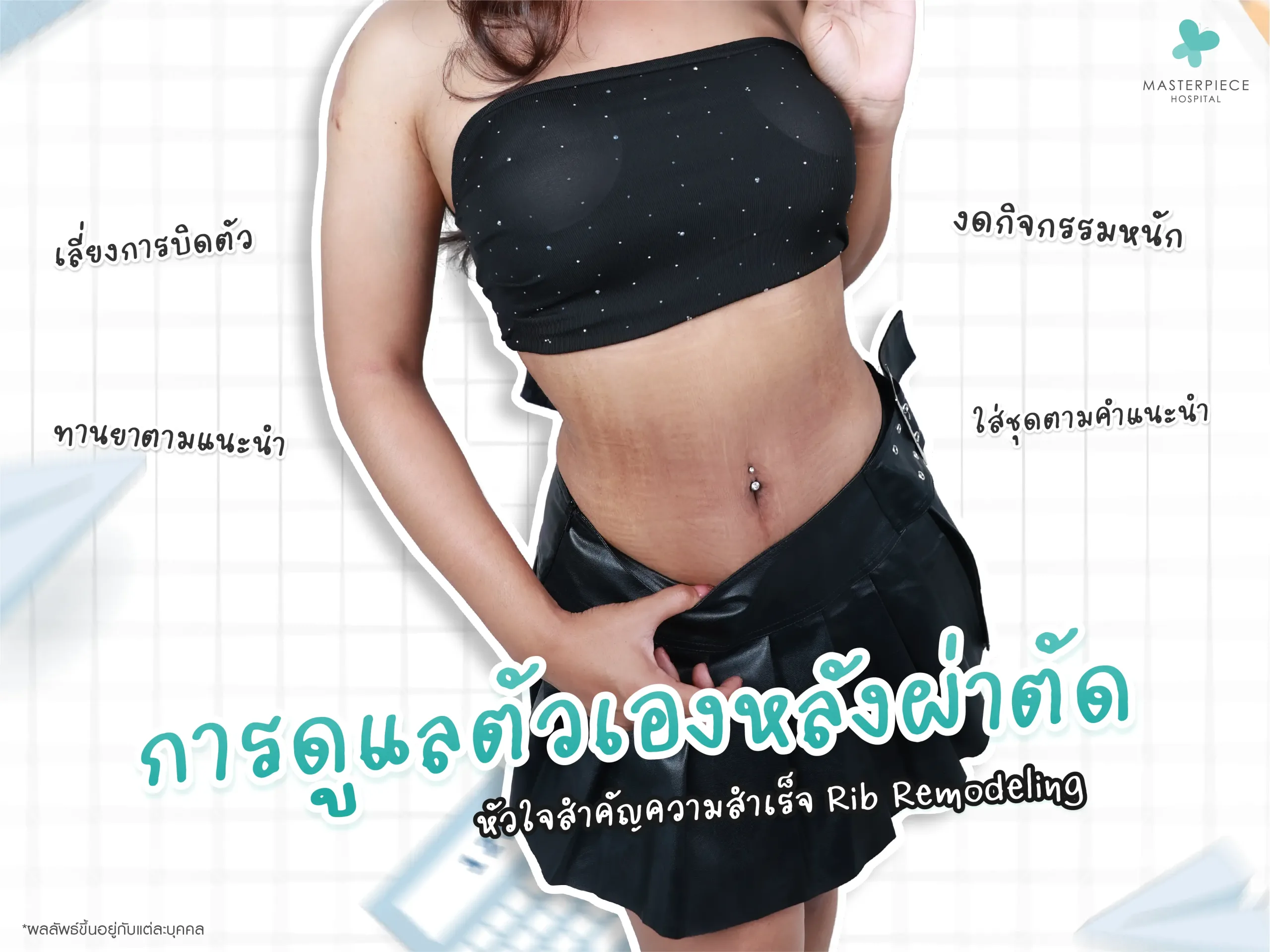 การดูแลตัวเองหลังผ่าตัด Rib modeling