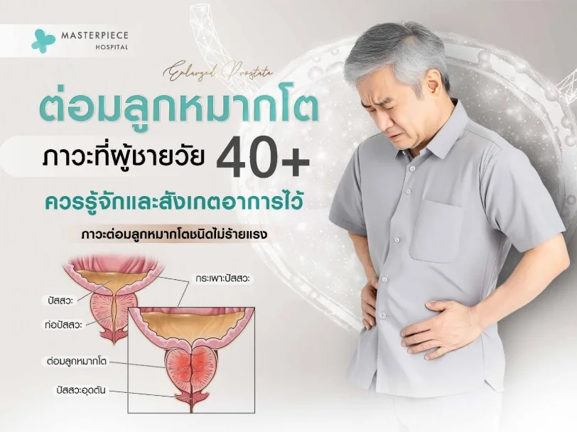 ต่อมลูกหมากโต ภาวะที่ผู้ชายวัย 40+ ควรรู้จักและสังเกตอาการไว้