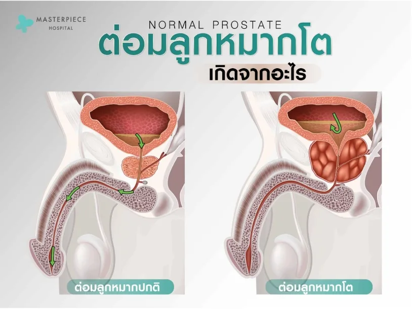 ต่อมลูกหมากโตเกิดจากอะไร