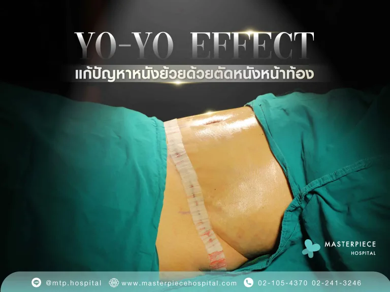 โยโย่เอฟเฟค แก้ปัญหาหนังย้วยด้วยตัดหนังหน้าท้อง
