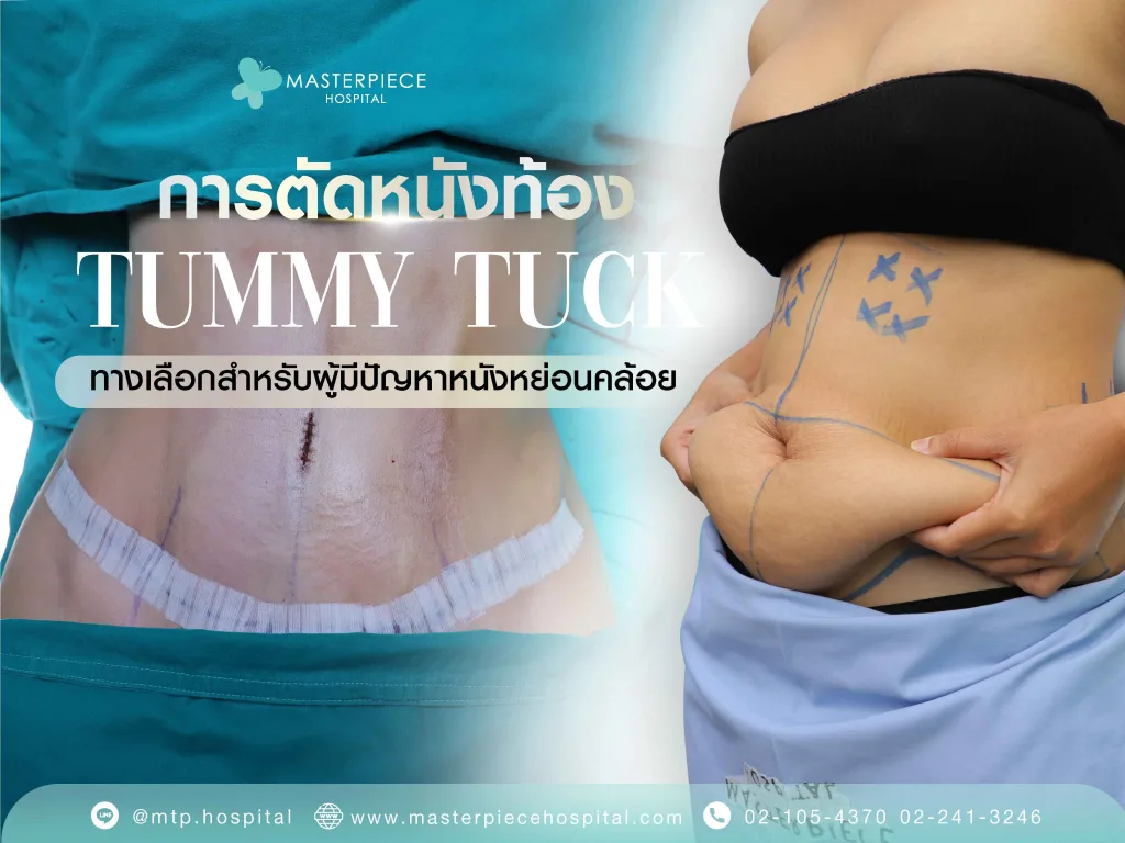 การตัดหนังหน้าท้อง (Tummy Tuck): ทางเลือกสำหรับผู้มีปัญหาหนังหย่อนคล้อย
