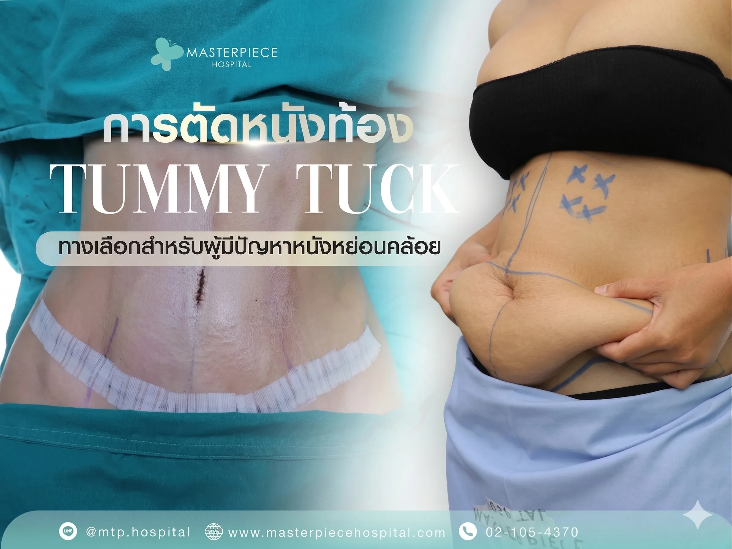การตัดหนังหน้าท้อง