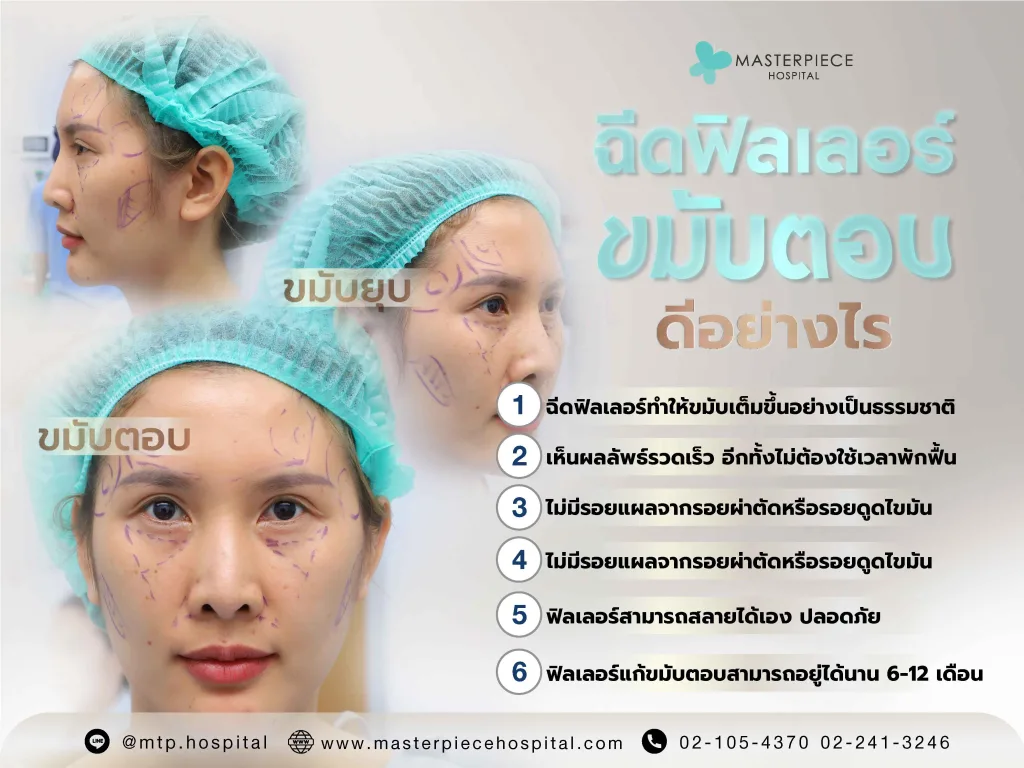 ฉีดฟิลเลอร์ขมับดีอย่างไร