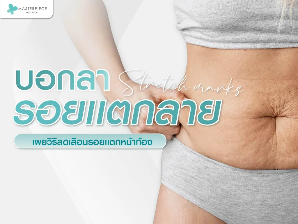 บอกลารอยแตกลาย เผยวิธีลดเลือนรอยแตกหน้าท้องให้ผิวสวย