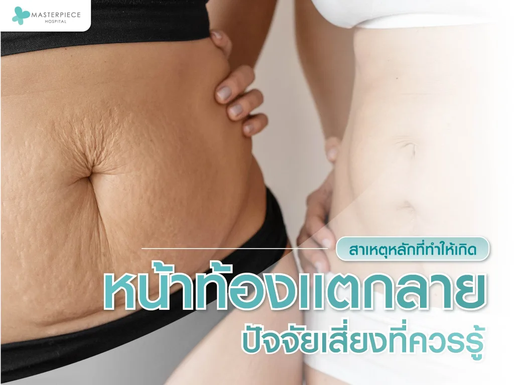 สาเหตุหลักที่ทำให้เกิด หน้าท้องแตกลาย ปัจจัยเสี่ยงที่ควรรู้