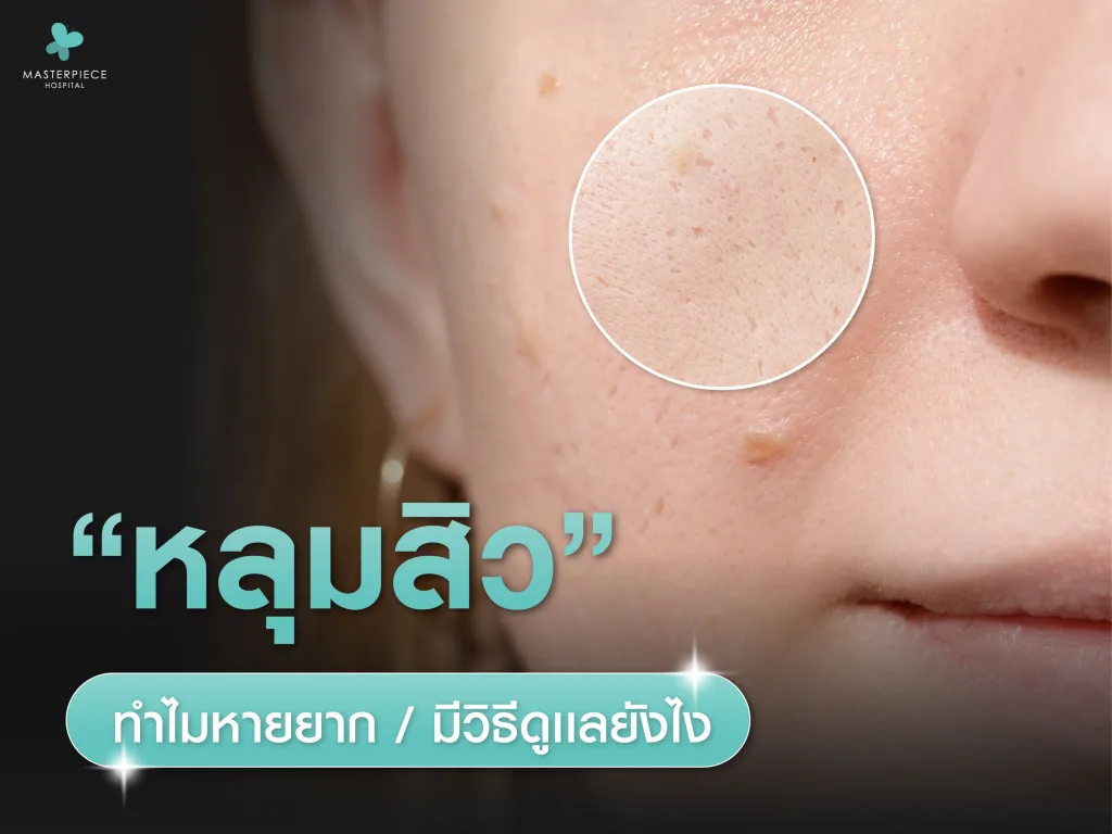 หลุมสิวคืออะไร ทำไมบางคนหายยาก และมีวิธีดูแลยังไงบ้าง