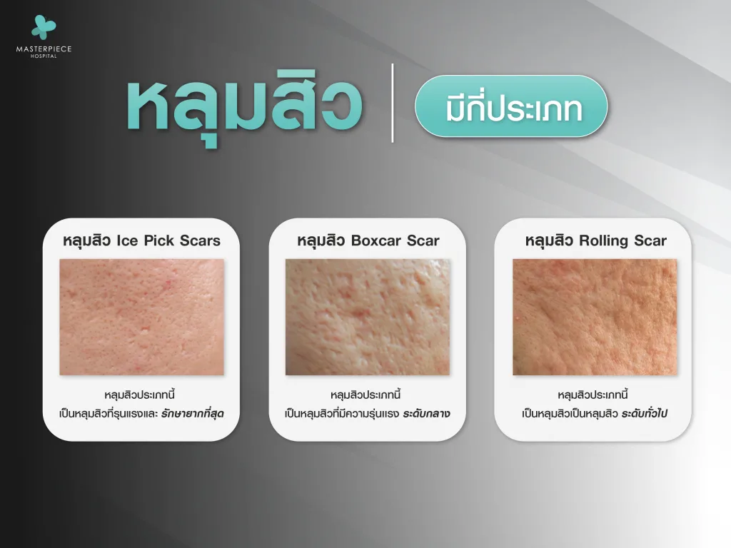 หลุมสิวมีกี่ประเภท