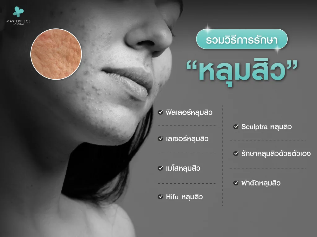 รวมวิธีการรักษาหลุมสิว