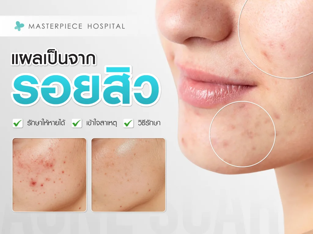 รอยแผลเป็นจากสิว รักษาให้หายได้ เข้าใจสาเหตุ วิธีรักษา