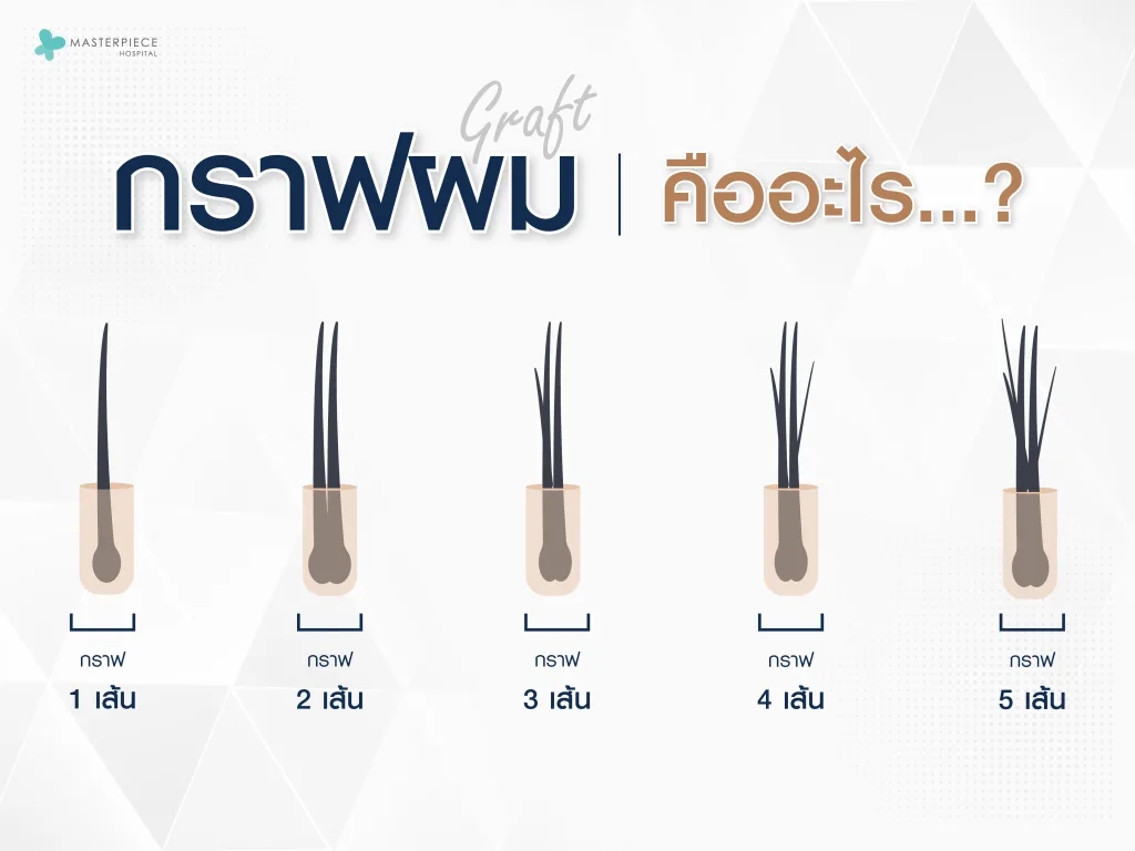 กราฟผม (Graft) คืออะไร
