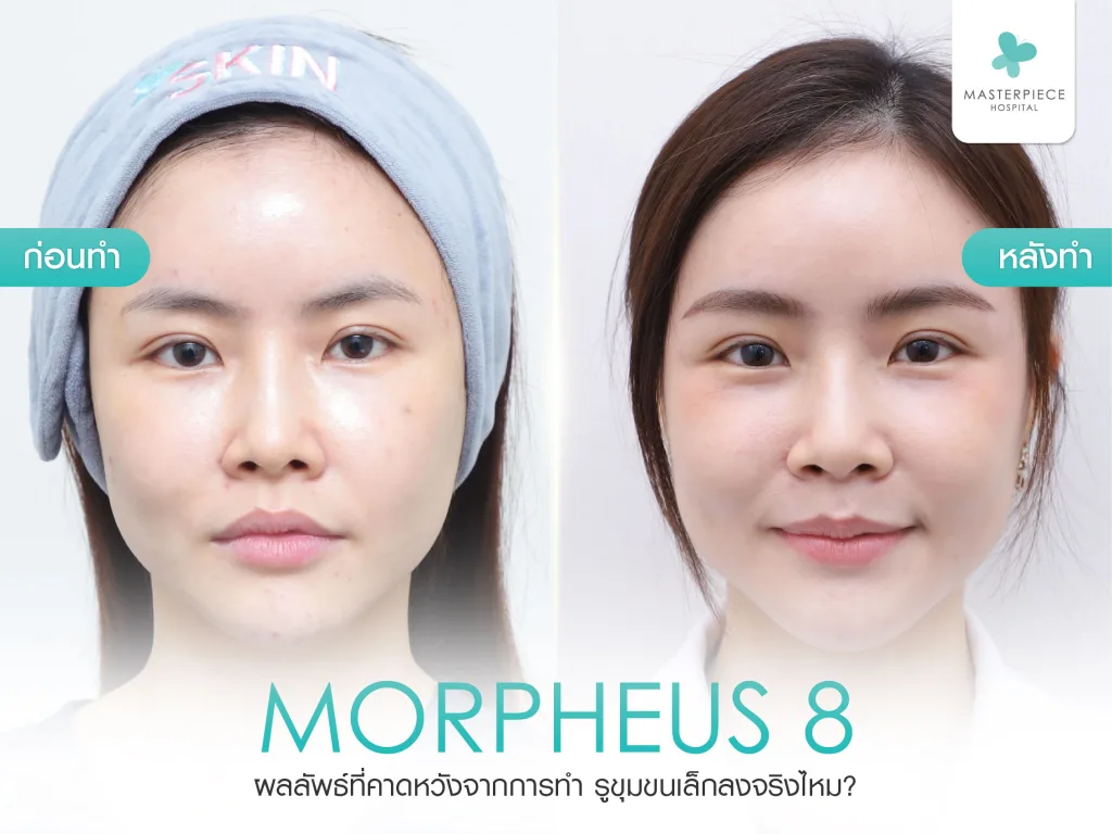 ผลลัพธ์ที่คาดหวังจากการทำ Morpheus8 รูขุมขนเล็กลงจริงไหม?