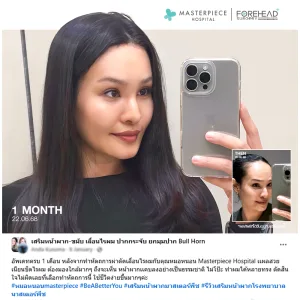 รีวิวศัลยกรรมหน้าผากคุณกุสุมา ทานะเวช