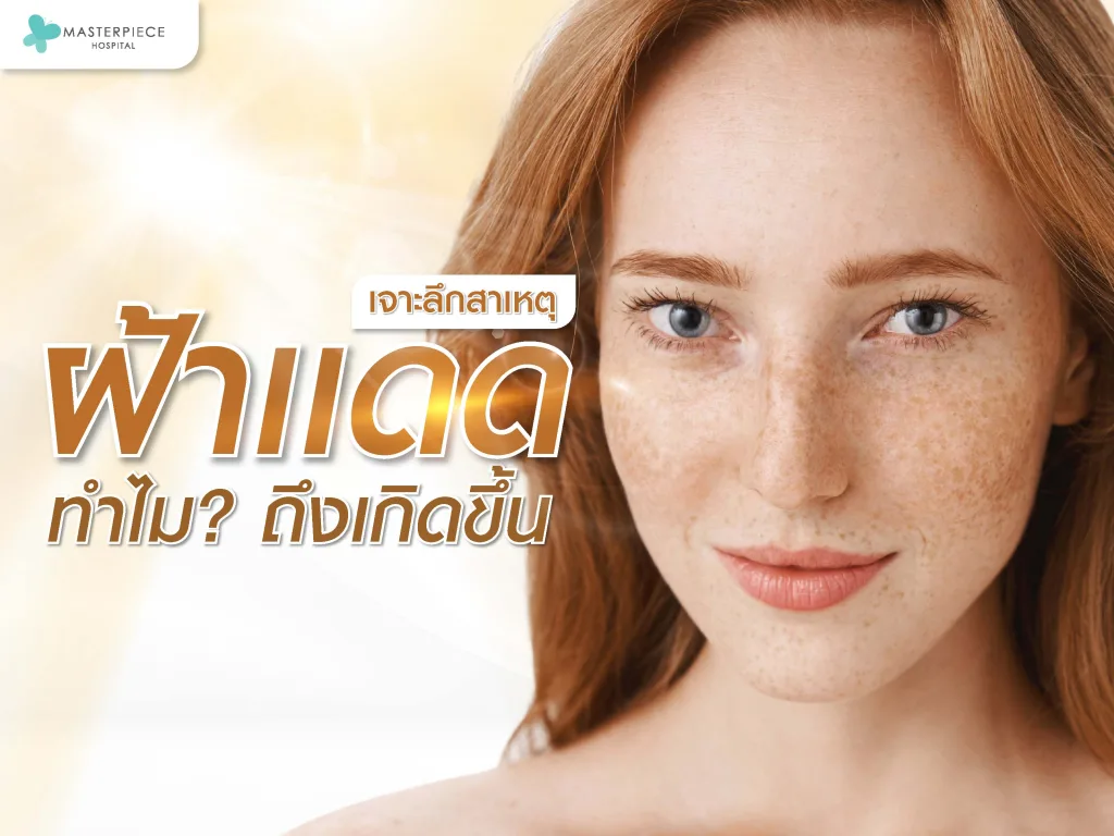 เจาะลึกสาเหตุฝ้าแดด ทำไมฝ้าแดดถึงเกิดขึ้น?