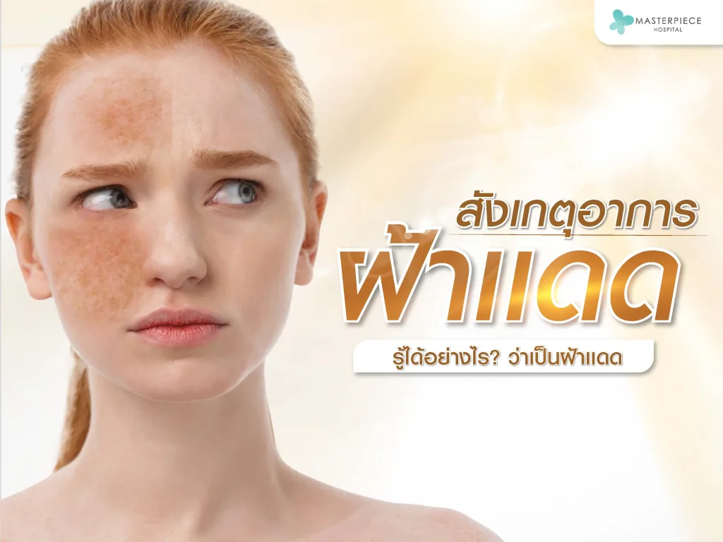 สังเกตอาการฝ้าแดด รู้ได้อย่างไรว่าเราเป็นฝ้าแดด?