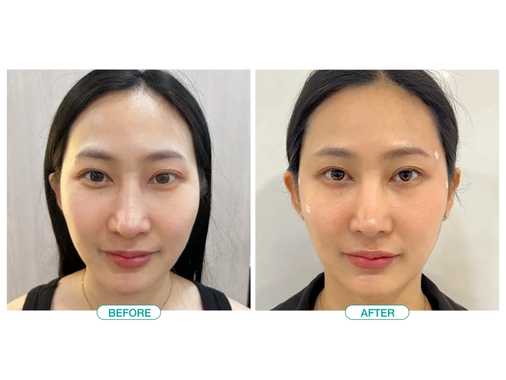 โรงพยาบาลมาสเตอร์พีชมีรีวิวฉีดฟิลเลอร์ขมับหลากหลายเคส แสดงให้เห็นถึงความพึงพอใจและประสบการณ์ตรงของลูกค้าที่เคยเข้าใช้บริการฉีดฟิลเลอร์ขมับ ด้วยรีวิวที่หลากหลาย มั่นใจได้ว่าจะได้ผลลัพธ์ตรงตามความต้องการ