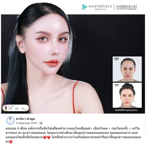 รีวิวศัลยกรรมหน้าผากคุณวัชรีรัศมิ์ คำมูล