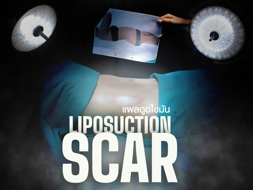 แผลดูดไขมัน เรื่องที่ควรรู้ก่อนทำ พร้อมวิธีดูแลหลังทำให้แผลหายไว