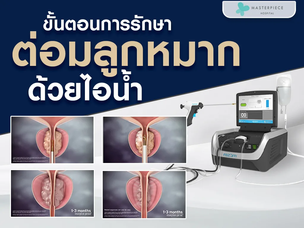 ขั้นตอนการรักษาต่อมลูกหมากด้วยไอน้ำ